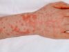 Home Remedies and Diet Plans for B Cepacia Infection