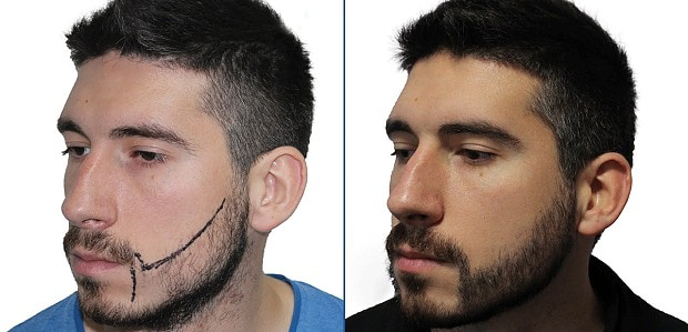 Hair Transplant Turkey